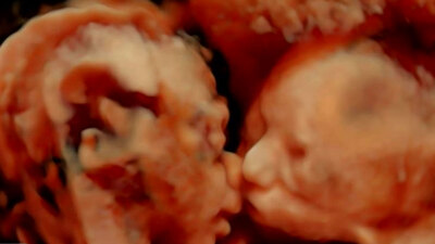 İkizlerin anne karnındaki şaşırtan görüntüsü!