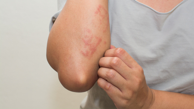 Sedef hastalarına tüyolar!