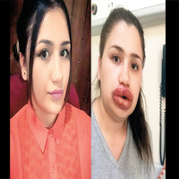 Silikon faciası! Dudakları alınabilir!