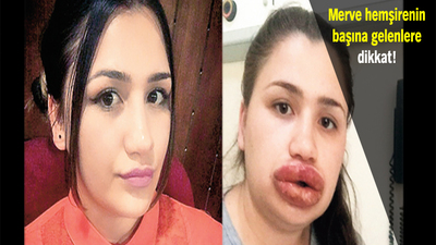 Silikon faciası! Dudakları alınabilir!