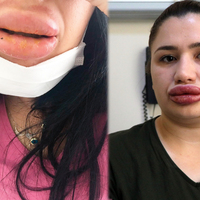 Dudak silikonu faciasında yeni mağdur çıktı!