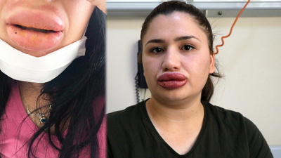 Dudak silikonu faciasında yeni mağdur çıktı!