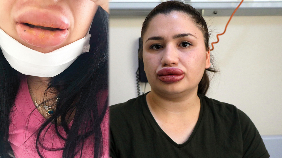 Dudak silikonu faciasında yeni mağdur çıktı!