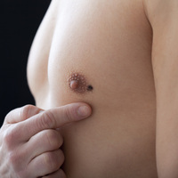 Her saat başı 1 kişi melanom yüzünden ölüyor!