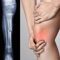 Kırık kemikler ameliyatsız iyileşecek