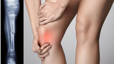 Kırık kemikler ameliyatsız iyileşecek