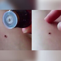 Bacağına saplanan keneyi böyle çıkardı...