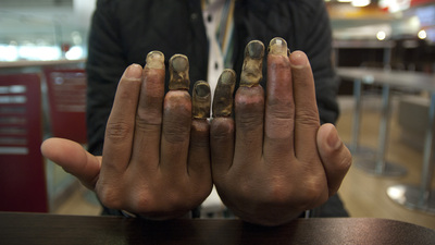 His Europe dream ended up melted fingers in Turkey