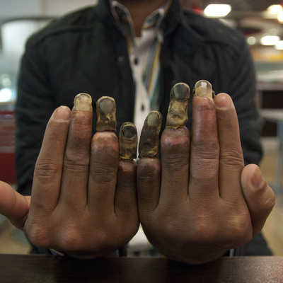 His Europe dream ended up melted fingers in Turkey