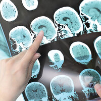 Alzheimer'ın en büyük düşmanı bulundu!