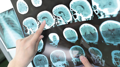 Alzheimer'ın en büyük düşmanı bulundu!