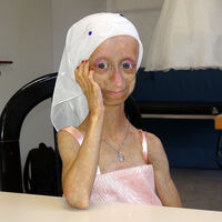 Yaşlanma hastası Gamze acılarına daha fazla dayanamadı