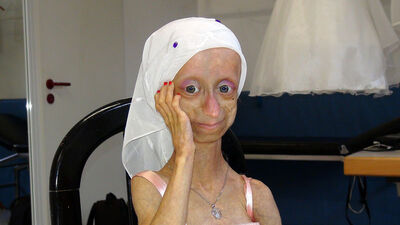 Yaşlanma hastası Gamze acılarına daha fazla dayanamadı