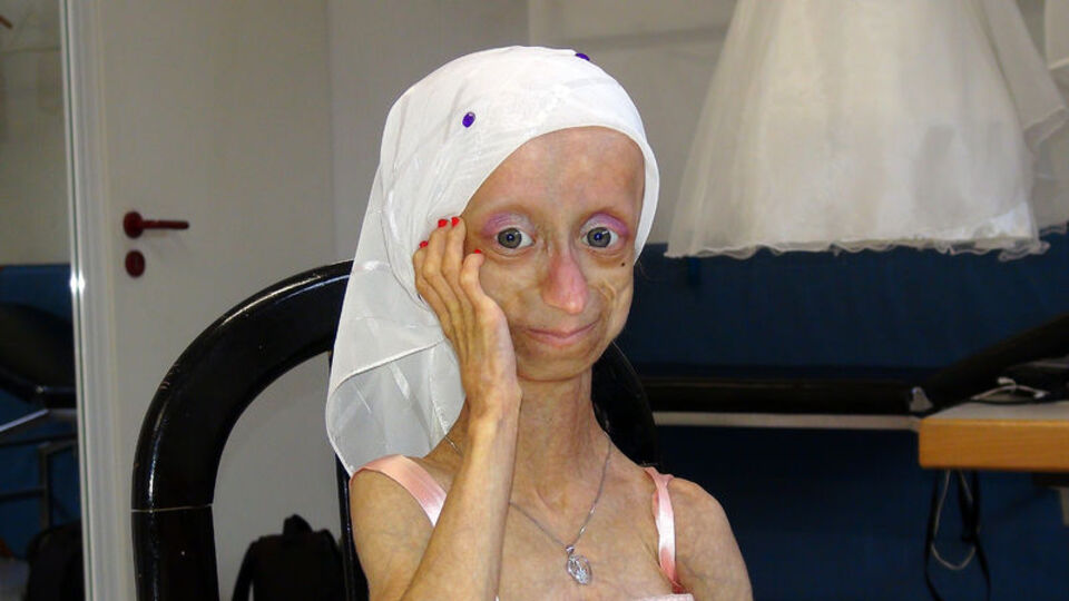 Yaşlanma hastası Gamze acılarına daha fazla dayanamadı