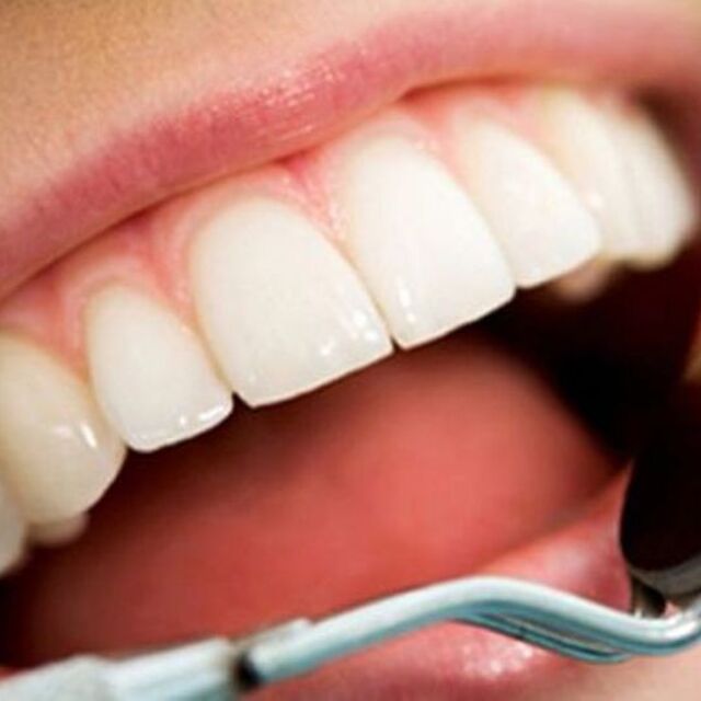 Uzmanlar uyardı! Diş beyazlatan market ürünleri kullanılmamalı!