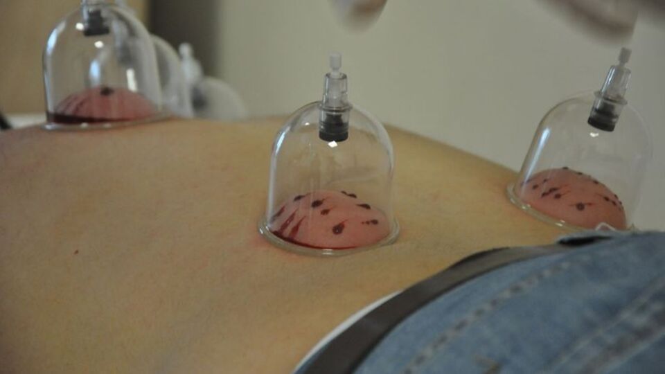 Devlet hastanesinde hacamat ve akupunktur polikliniği açıldı!