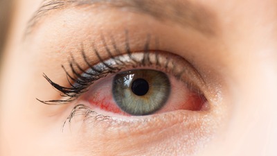 Gözlerinizde kızarıklık varsa ihmal etmeyin! Çünkü...