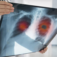 O veri korkuttu! Kansere yakalananların sayısı evlenenlerden daha fazla...