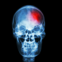 İnmede ilk 4,5 saat kuralına dikkat!