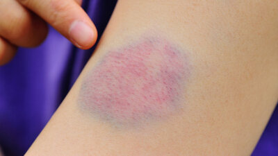 Ciltte meydana gelen morarmalar neyin belirtisi?