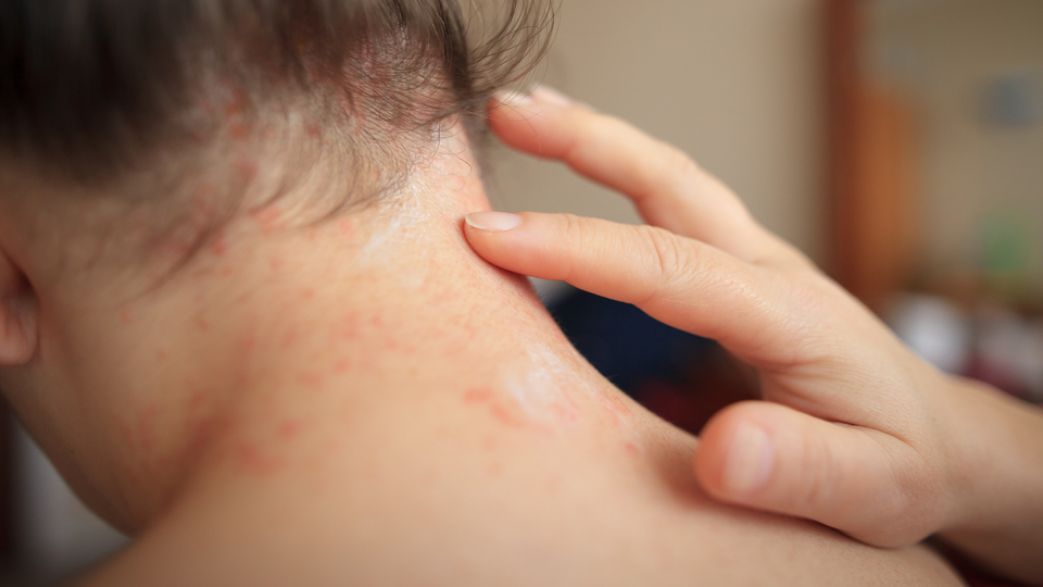 Sedef hastalarına çok önemli uyarı!