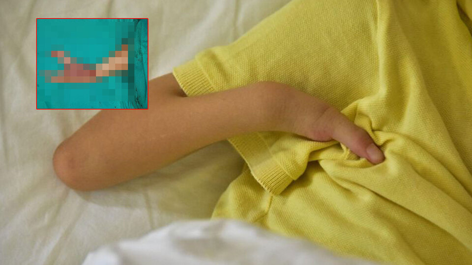 Ellerinde tek parmak bulunan çocuğa parmak nakli yapıldı!