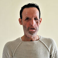 Yüz nakilli Recep Sert patron oldu!