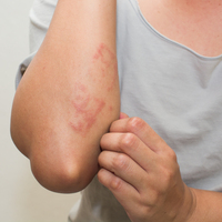 Sedef hastalığının iyileşmesine katkı sağlıyor!