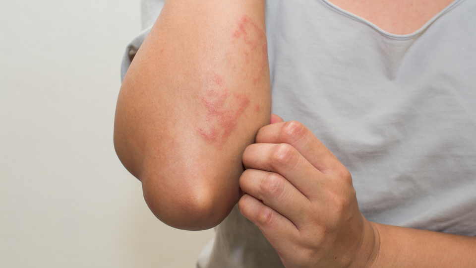 Sedef hastalığının iyileşmesine katkı sağlıyor!