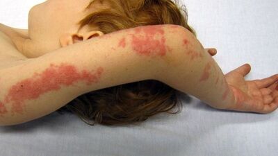 Vücudunun her yerini kaplayan kırmızı lekeler hayatını kabusa çevirdi!