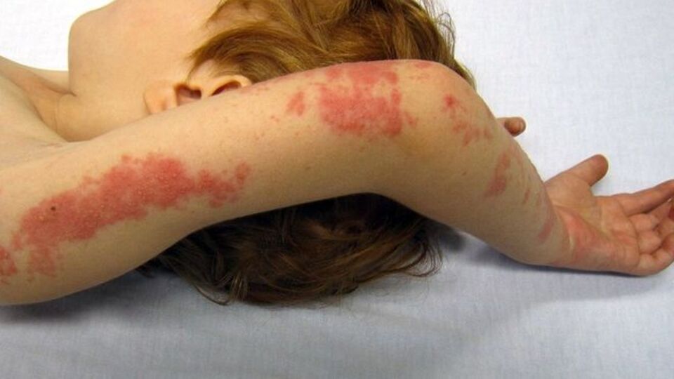 Vücudunun her yerini kaplayan kırmızı lekeler hayatını kabusa çevirdi!
