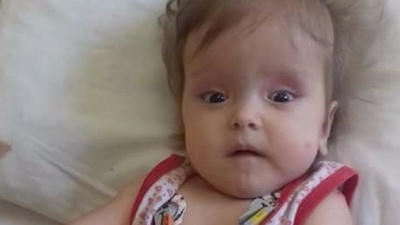 11 aylık Sümeyye'nin yaşı küçük derdi büyük!