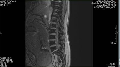 8 aylık hamileyken fıtığı patladı doktorlar sorunu bakın nasıl çözdü...