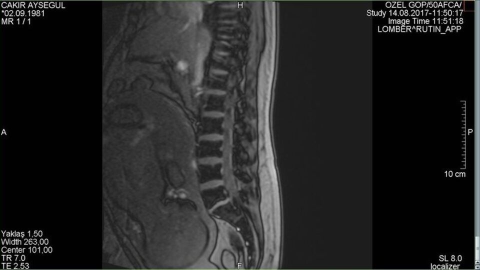 8 aylık hamileyken fıtığı patladı doktorlar sorunu bakın nasıl çözdü...