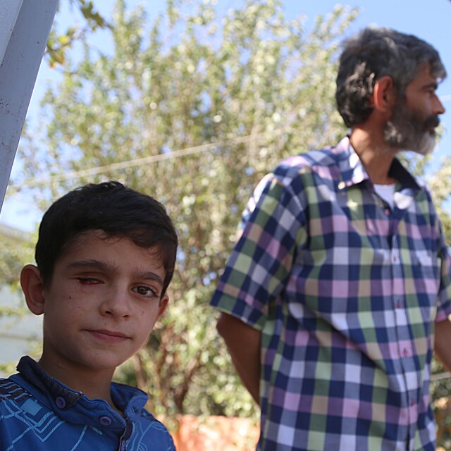 Suriyeli Mahmut protez göze kavuşuyor