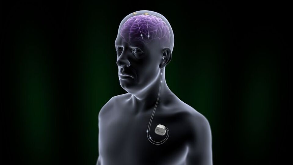 Beyin piliyle Parkinson'un tedavisi mümkün hale geliyor