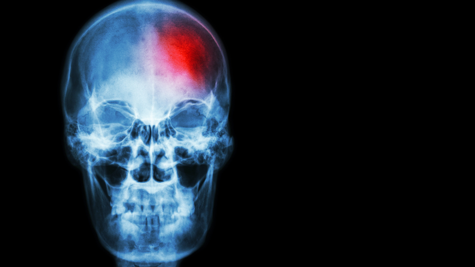 ''Otoyol kenarlarında yaşayanlar inme riski altında''