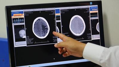 Agresif beyin kanseri tümörlerinin tedavisinde ümit veren keşif!