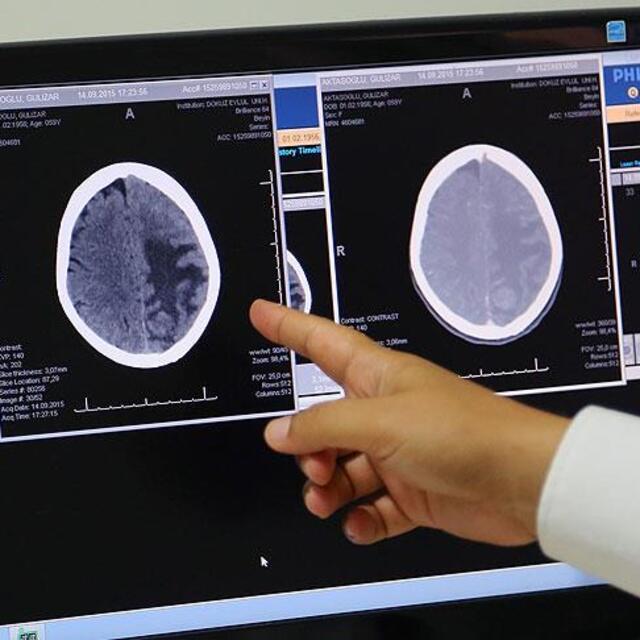 Agresif beyin kanseri tümörlerinin tedavisinde ümit veren keşif!