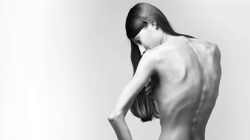 Anoreksiyanın en sık görüldüğü yaş aralığı 12-25