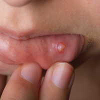 Yüz, boyun ve ağızda iyileşmeyen yara kanser olabilir