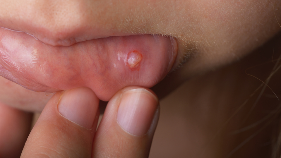 Yüz, boyun ve ağızda iyileşmeyen yara kanser olabilir