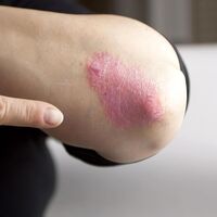 Sedef hastalarının yüzde 40'ı ayrımcılığa uğradığını düşünüyor