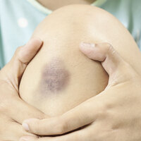 Çocuğunuzun dizlerinde morluk oluyorsa dikkat!