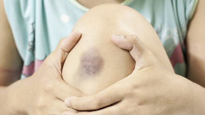 Çocuğunuzun dizlerinde morluk oluyorsa dikkat!