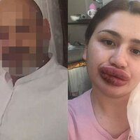 Mahkemeden karar çıktı! İşte sahte botoksçunun cezası