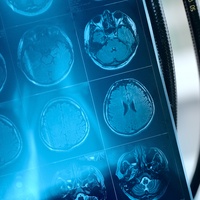 Baş ağrısını yıllarca sahne stresi sandılar, beyninde damar yumağı çıktı