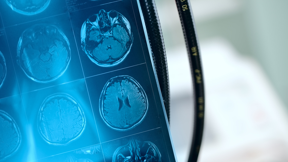 Baş ağrısını yıllarca sahne stresi sandılar, beyninde damar yumağı çıktı