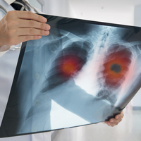 10 kişiden 8’i KOAH hastası olduğunu bilmiyor