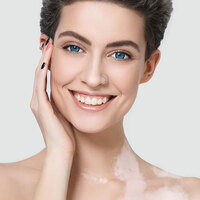 Halk arasında beyazlama hastalığı olarak biliniyor! İşte vitiligoya dair merak edilenler...